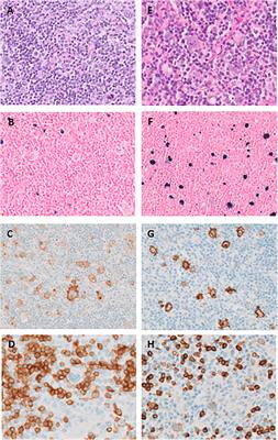 Frontiers | case report: xmen disease: a patient with recurrent hodgkin